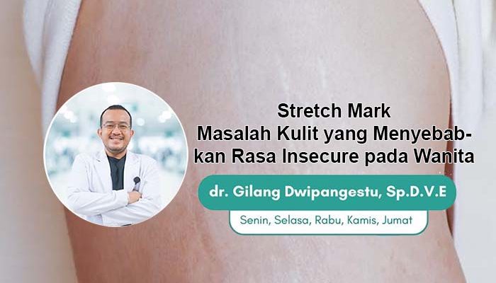 Stretch Mark: Masalah Kulit yang Menyebabkan Rasa Insecure pada Wanita