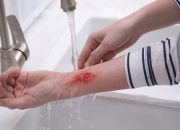 RSUD Pandega Bagikan Tips Pertolongan Pertama pada Luka Bakar