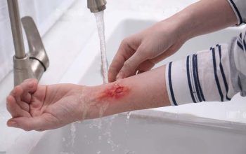 PANGANDARAN (JM) - RSUD Pandega Pangandaran baru-baru ini membagikan informasi penting melalui media sosial mereka mengenai pertolongan pertama yang dapat dilakukan untuk mengatasi luka bakar. Dalam unggahan tersebut, rumah sakit menekankan pentingnya penanganan cepat dan tepat untuk mengurangi dampak luka bakar, baik ringan maupun serius. Menurut RSUD Pandega, langkah pertama yang harus dilakukan pada luka bakar adalah mendinginkan area yang terkena bakar dengan air mengalir selama minimal 20 menit. "Ini bertujuan untuk menghentikan proses pembakaran dan meringankan rasa sakit," tulis mereka. Selain itu, penting untuk tidak menggunakan es, salep, atau bahan lain yang tidak direkomendasikan pada luka bakar, karena dapat menyebabkan kerusakan jaringan kulit sehingga akan memperburuk kondisi. "Jangan mengoleskan mentega, pasta gigi ataupun lotion pada luka karena dapat terjadi infeksi dan memperparah cedera," tambahnya. Setelah mendinginkan luka, langkah selanjutnya adalah menutupi area yang terbakar dengan kain bersih atau perban. RSUD Pandega juga menyarankan agar pasien tidak mengupas kulit yang melepuh, karena bisa meningkatkan risiko infeksi. "Jika luka bakar lebih besar dari telapak tangan atau melibatkan wajah, tangan, kaki, atau area sensitif lainnya, segera cari pertolongan medis. Kami di RSUD Pandega siap membantu," imbuh manajemen rumah sakit. Sebagai tambahan, RSUD Pandega Pangandaran mengingatkan masyarakat untuk tidak mengabaikan kesehatan mereka. Pemeriksaan rutin sangat penting untuk mendeteksi dan mencegah masalah kesehatan sebelum menjadi serius. "Kami mengundang Anda untuk melakukan pemeriksaan kesehatan di fasilitas kami," ajak mereka. Jangan ragu untuk menghubungi RSUD Pandega Pangandaran untuk informasi lebih lanjut atau jika masyarakat membutuhkan bantuan medis. "Kesehatan masyarakat adalah prioritas kami!" tutupnya.