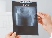 Hari Kanker Tulang Nasional Jadi Momentum Edukasi Kesehatan RSUD Pandega Pangandaran