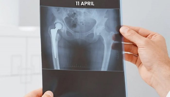 Hari Kanker Tulang Nasional Jadi Momentum Edukasi Kesehatan RSUD Pandega Pangandaran